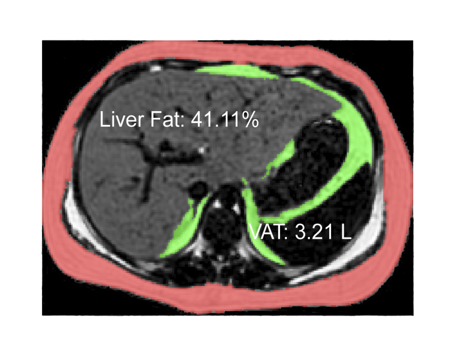 MRI Image of Fatty Liver in a Teenager MRI Image of Fatty Liver in a Teenager